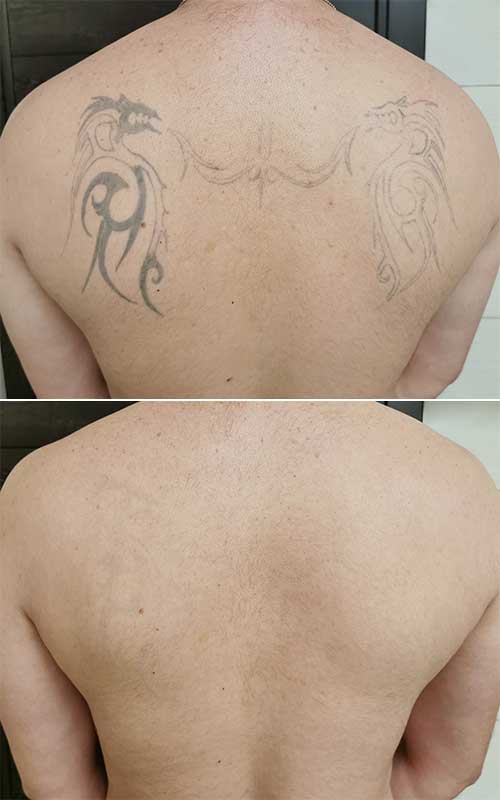 Удаление татуировок лазером - фото до и после